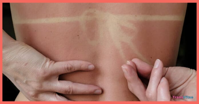 transgender sun protection
